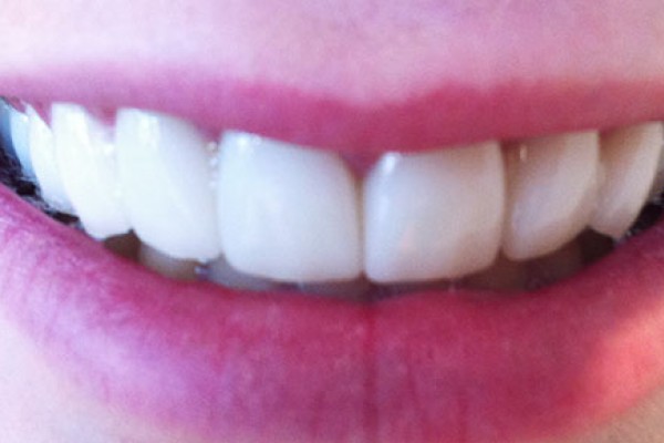 Jocelyn's teeth after