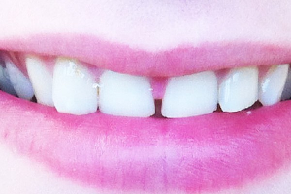 Jocelyn's teeth before