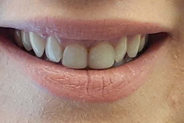Laura's teeth before