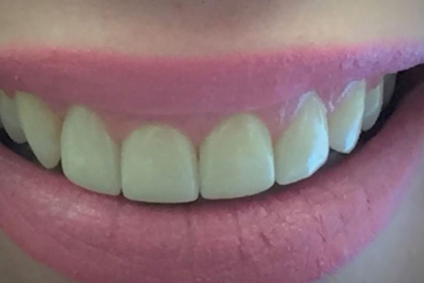 Laura's teeth after