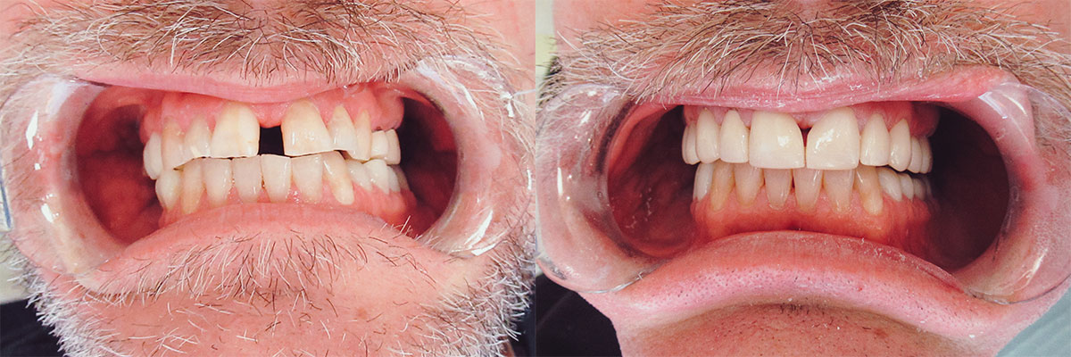 teeth before and after treatment