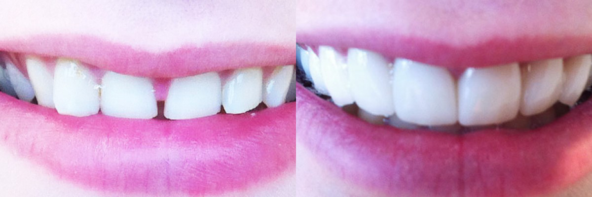 teeth before and after treatment