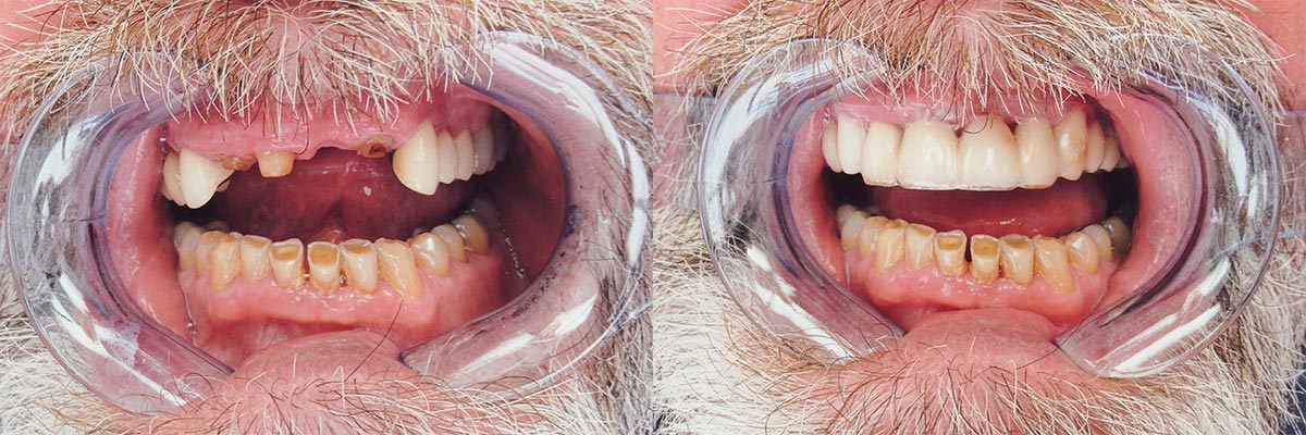 teeth before and after treatment