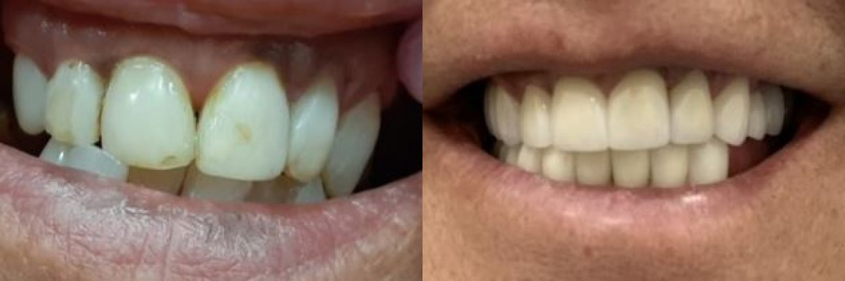 teeth before and after treatment