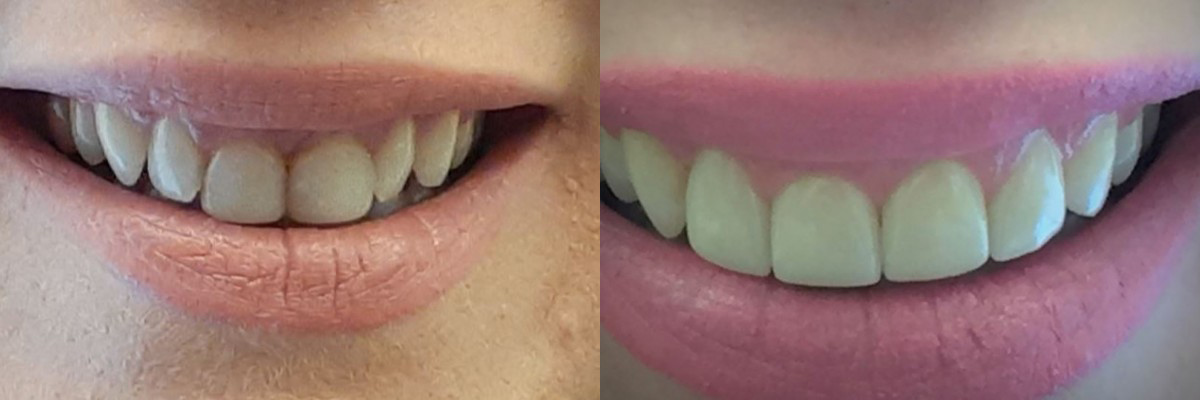 teeth before and after treatment