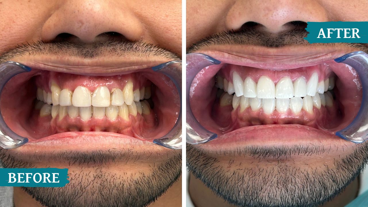 teeth before and after treatment