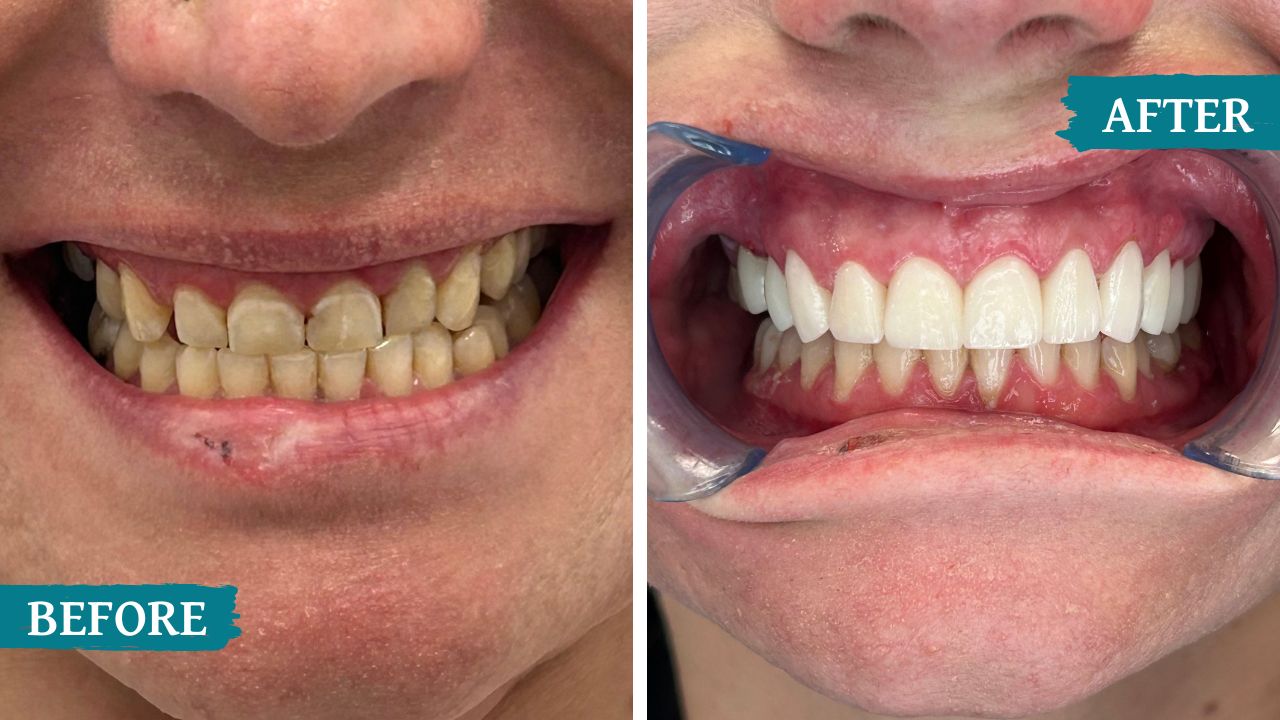 teeth before and after treatment