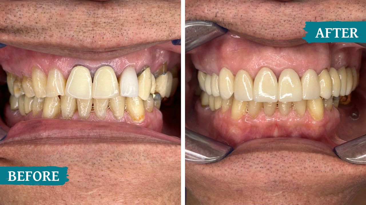teeth before and after treatment